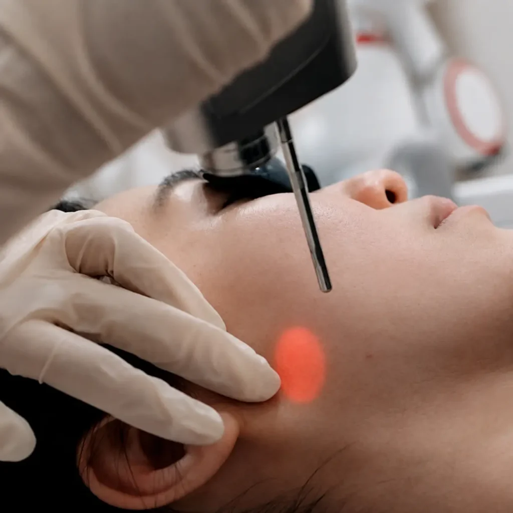 collagen laser