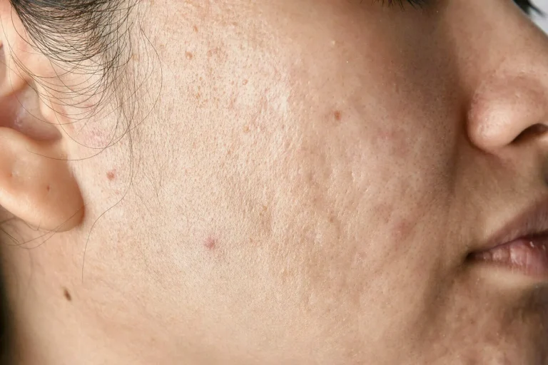 Acne-Scars-Removal-Treatments-edited-2