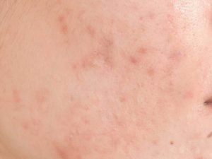 Acne Scar