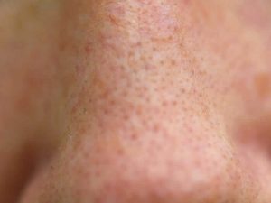 Enlarged Pores