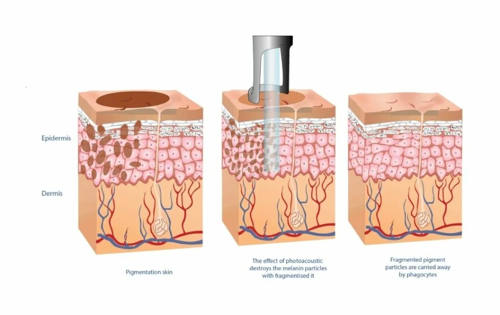 how-does-pico-laser-workjpeg
