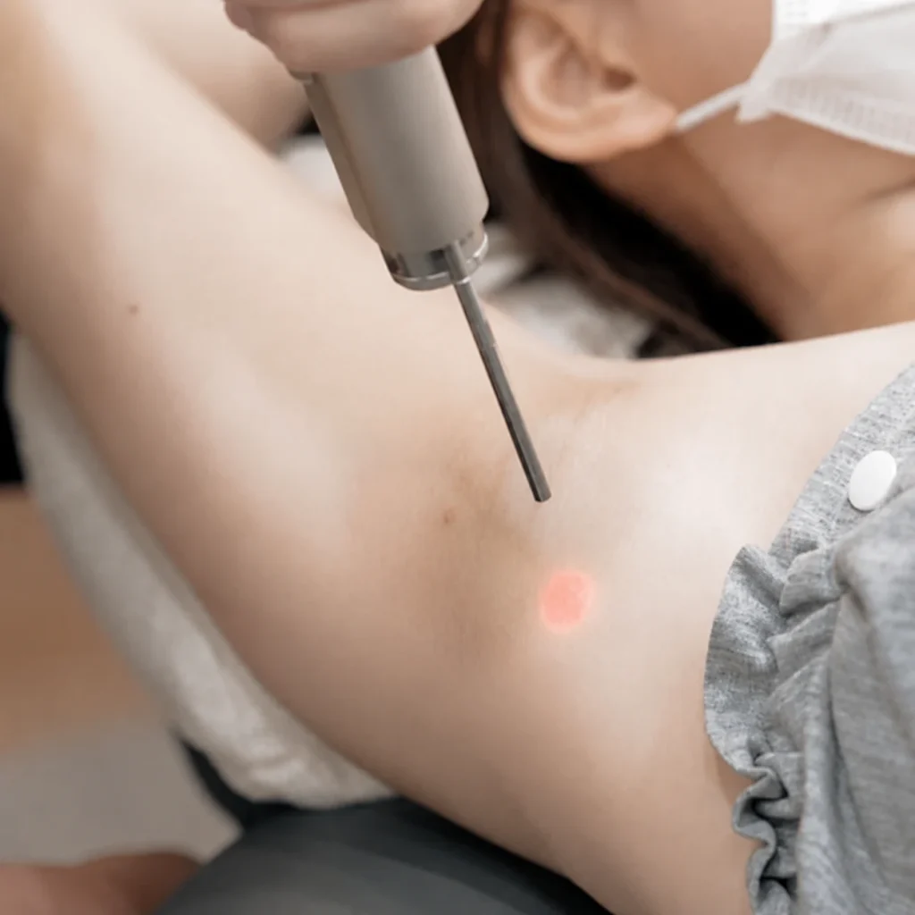 laser hair removal
