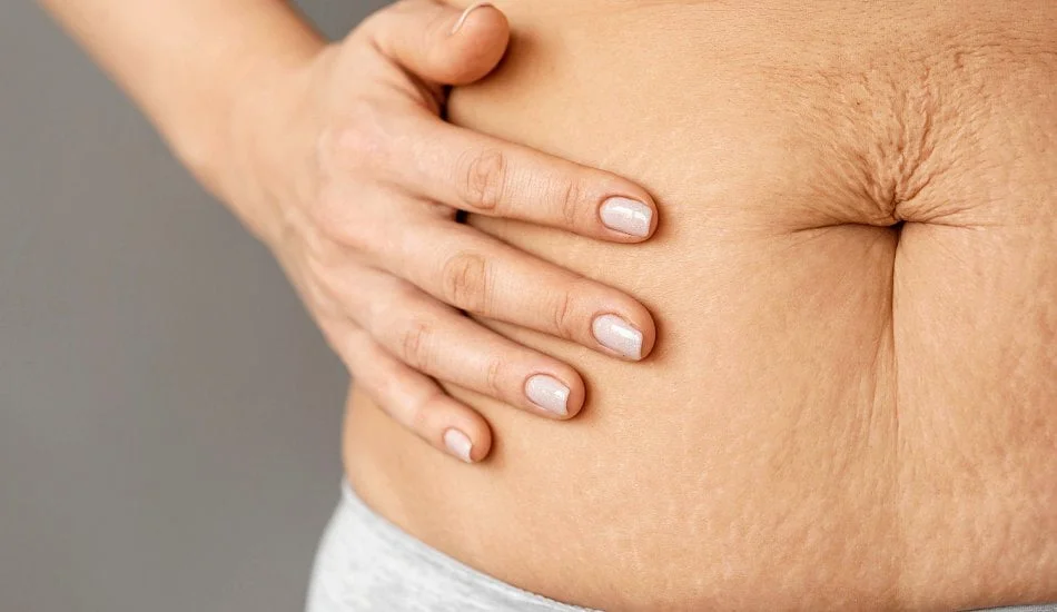 Get rid of stretch marks and regain confidence with aesthetic treatments