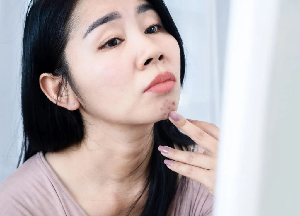 Pico Laser is effective in treating acne scars