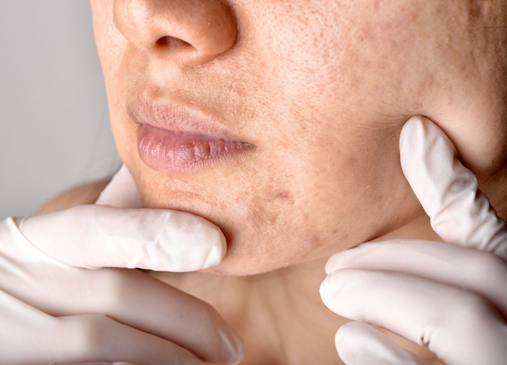 Say bye to surgical aesthetic treatments! Non-surgical acne scars treatments with V Medical Aesthetic!