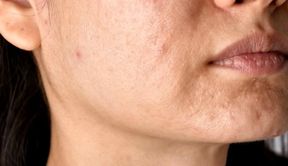 Best non-surgical treatments in Singapore to reduce acne scars