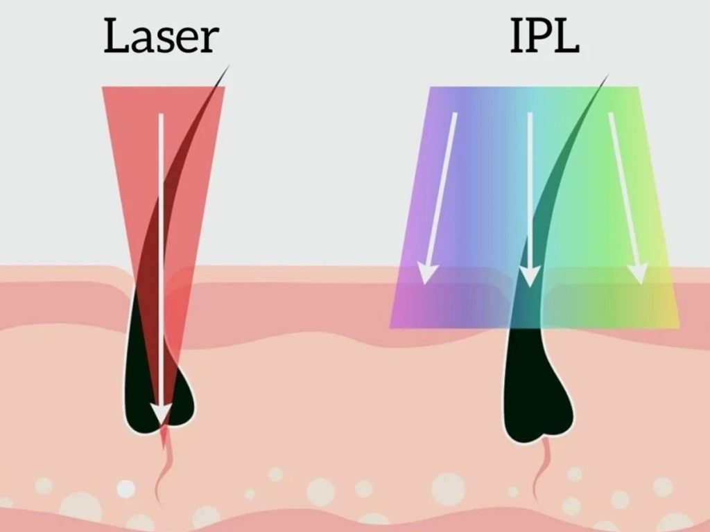 Laser Hair Removal 28 Nett Painless With Permanent Results