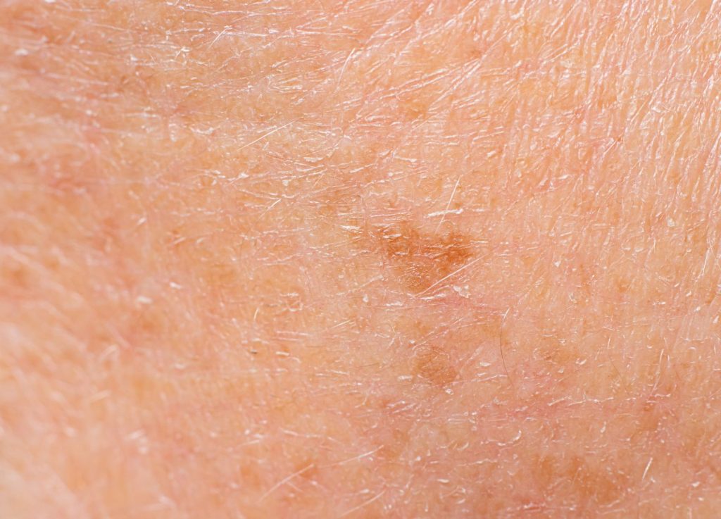 Get rid of age spots with Pico Laser