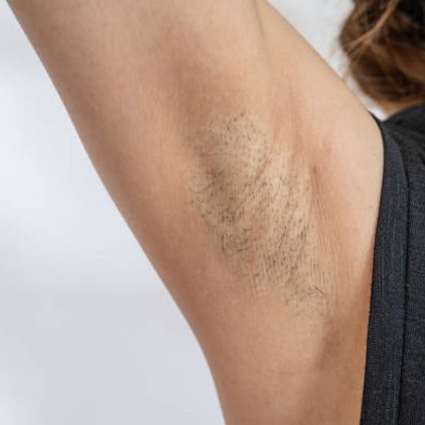 laser hair removal, underarm hair, armpit hair