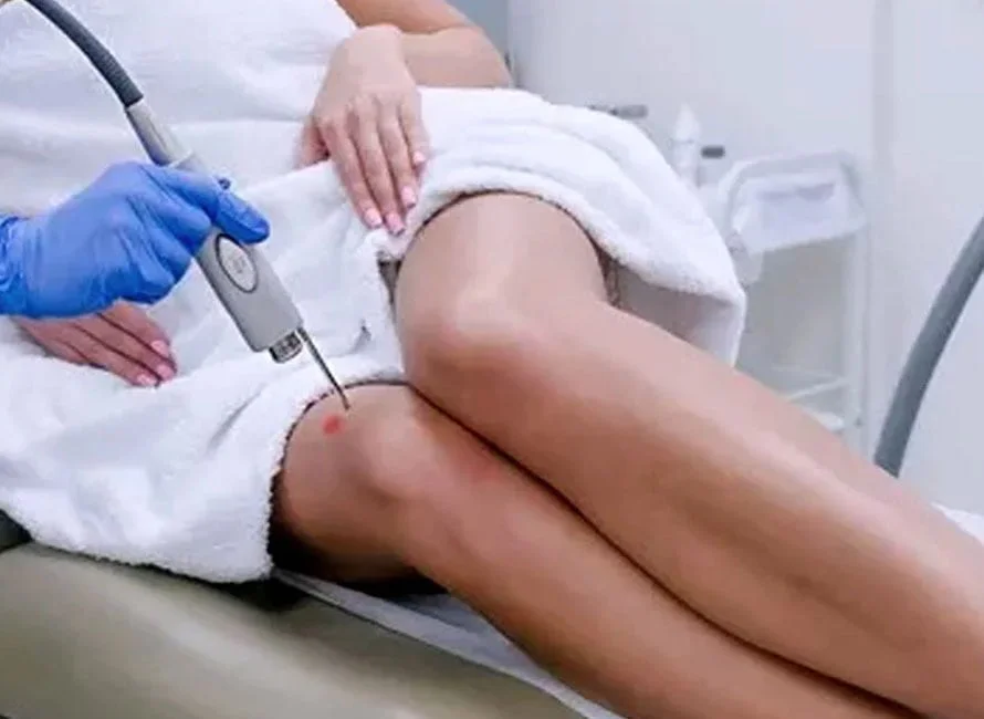 laser hair removal price