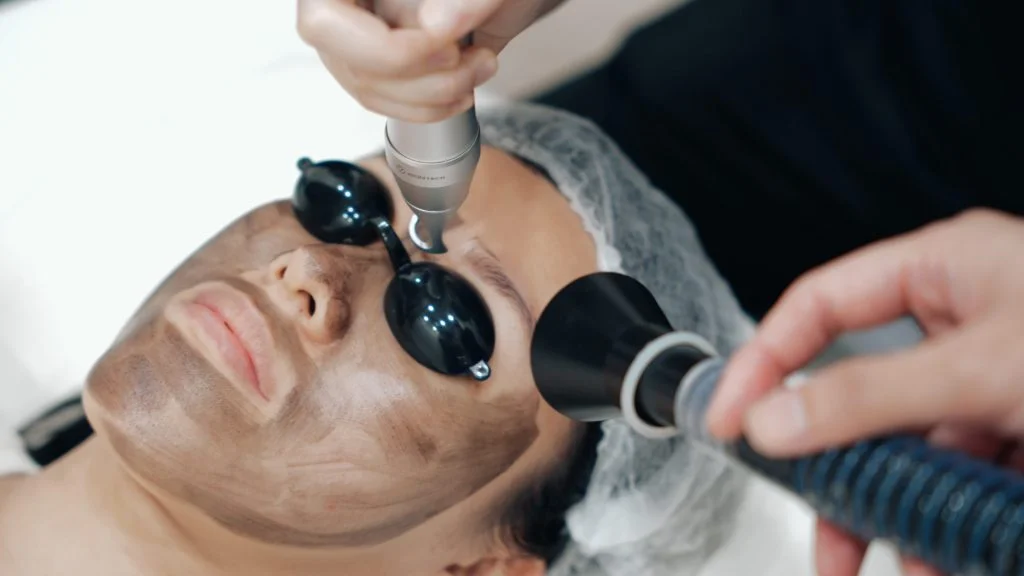 The rise of popularity in Carbon Laser Peel