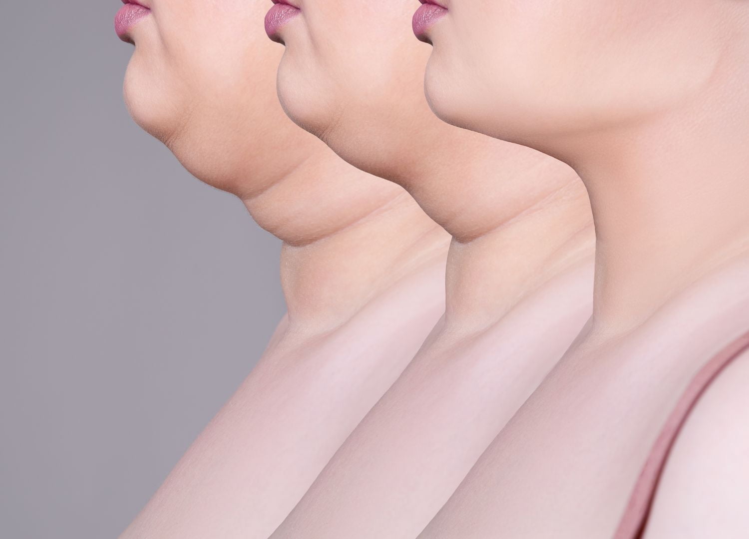 Let's find out the cause of double chin and how HIFU can treat it