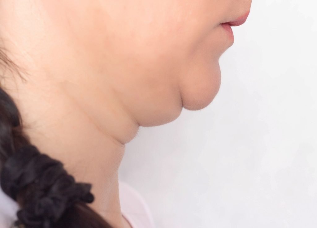 HIFU for double chin removal