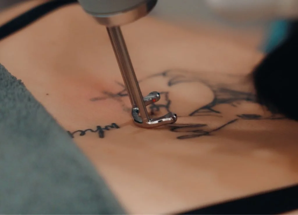 Remove tattoo with Pico Laser effectively