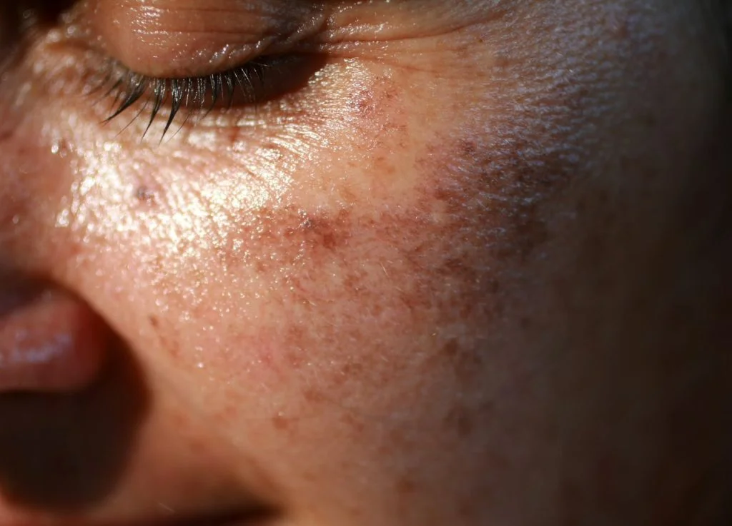 Do I Have Sun Spots Or Freckles?