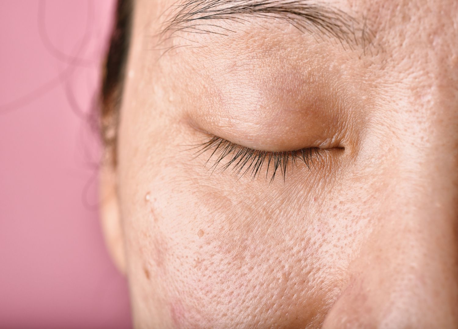 Pico Laser is a treatment that can treat multiple skin concerns