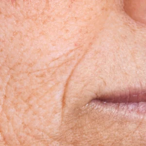 Skin Wrinkles
