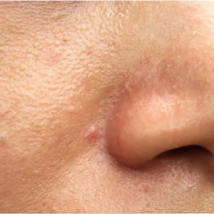Uneven Skin Texture