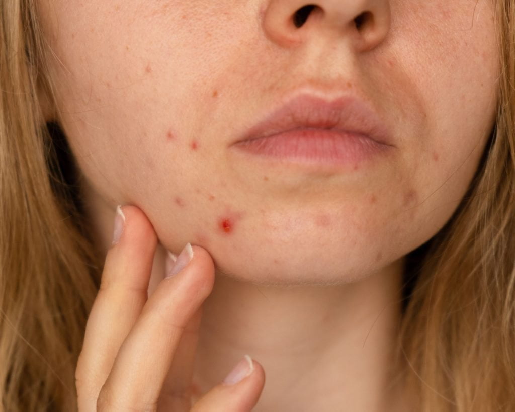 5 Common Questions About Acne Scars & How To Treat It