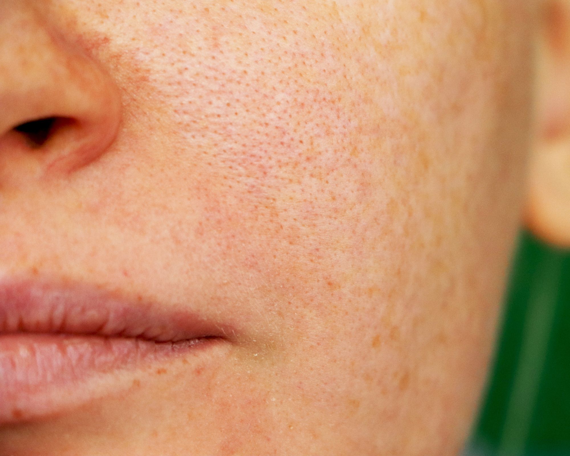Having Enlarged Pores Pico Laser is Here To Help