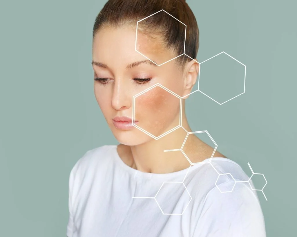 Pico Laser is the solution for dark spots