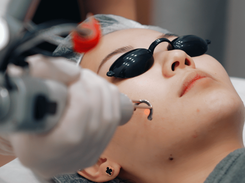 Pico Laser Treatments in Singapore