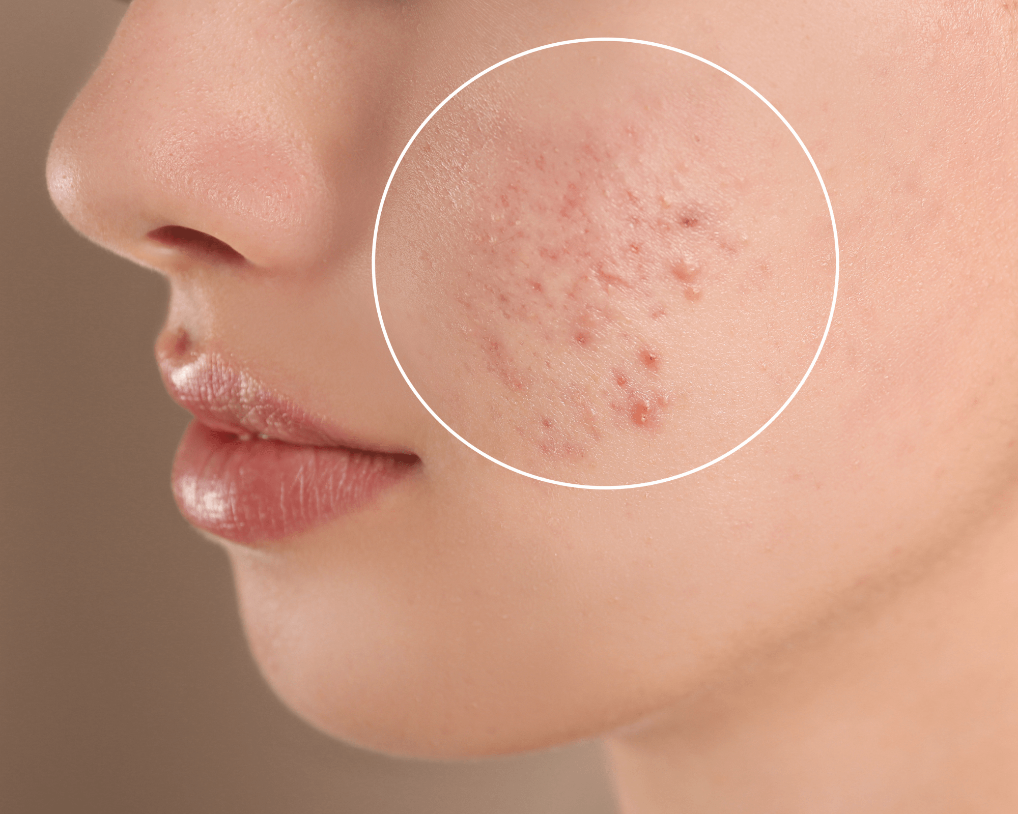 Acne are common, pico laser