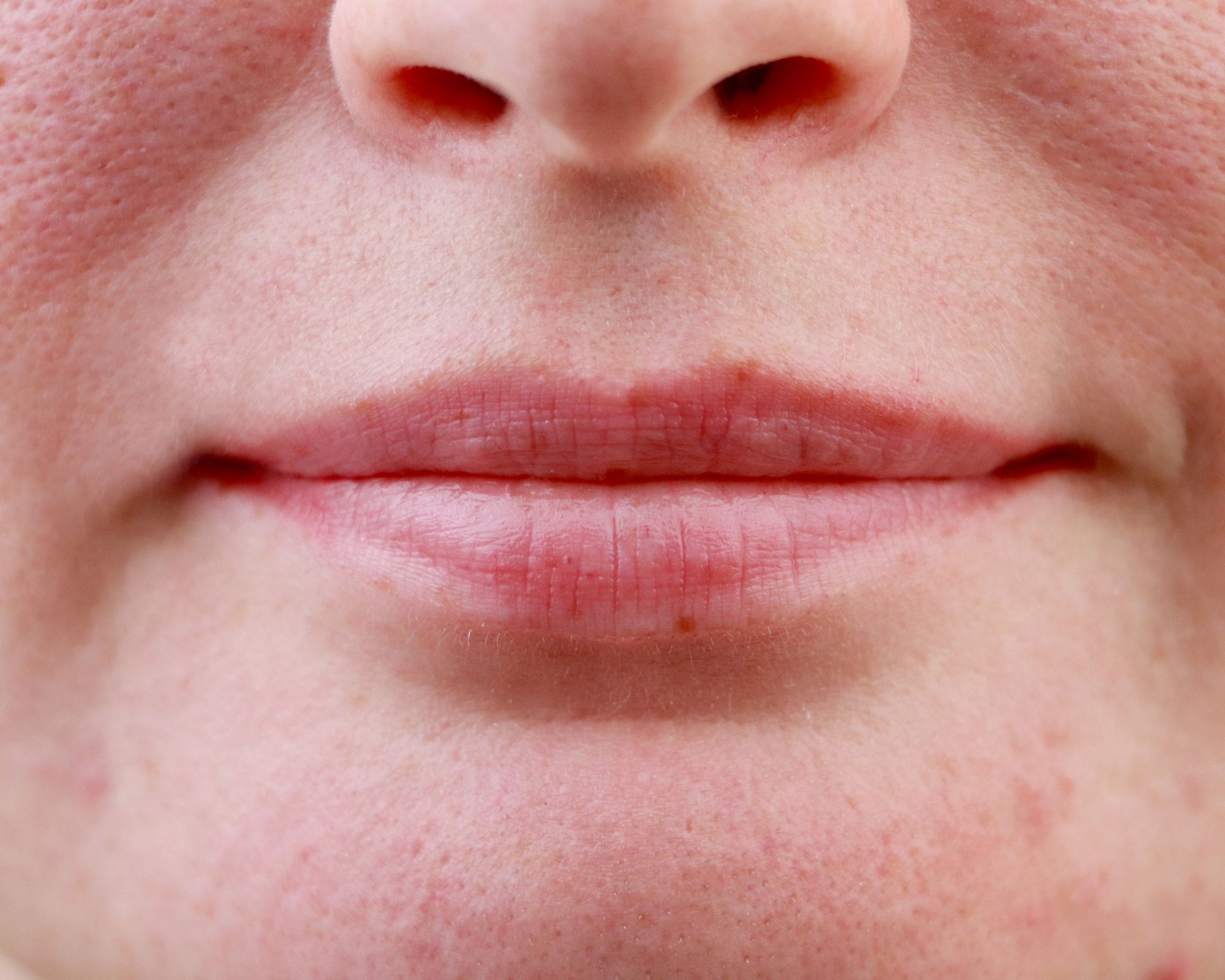 Smaller pores with Pico Laser