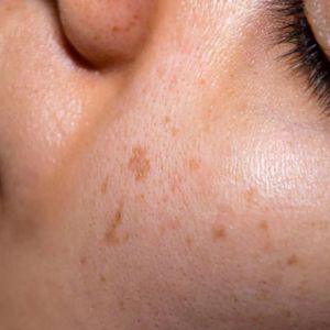 Age Spots