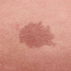 Birthmark