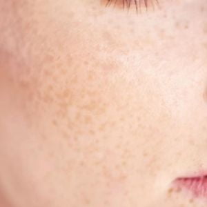 Freckles