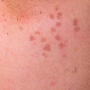 Horis Nevus