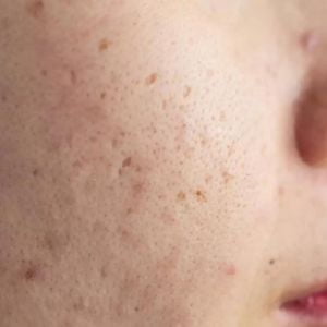 Hyper Pigmentation