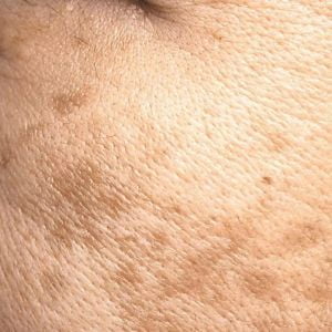 Melasma