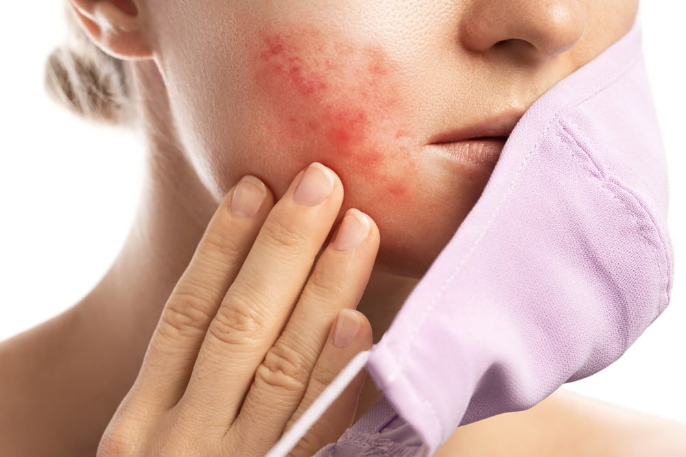 Understanding-Rosacea---Causes-Symptoms-and-Non-Surgical-Treatments-with-Sylfirm-X---VMED