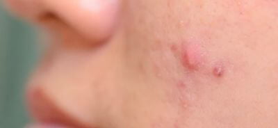 Papules