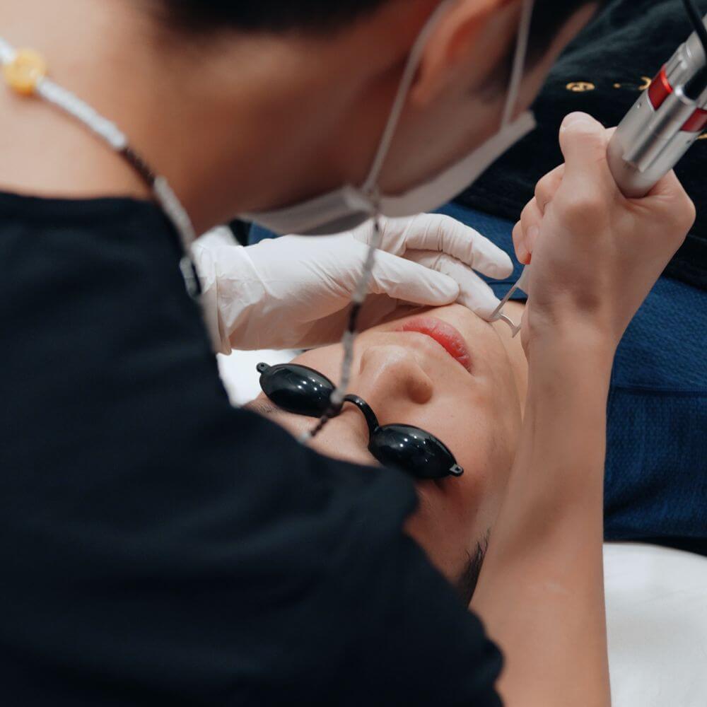 Pico Laser Treatment
