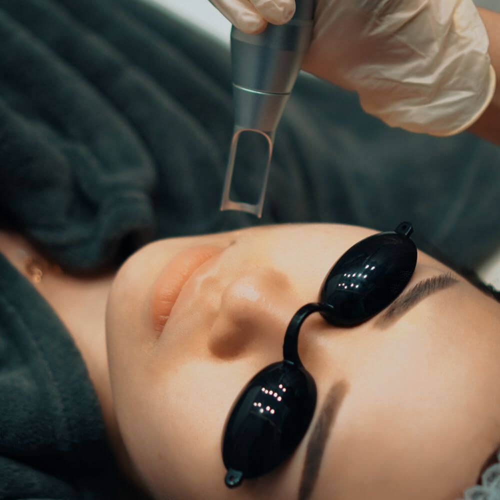 Pico Laser Treatment