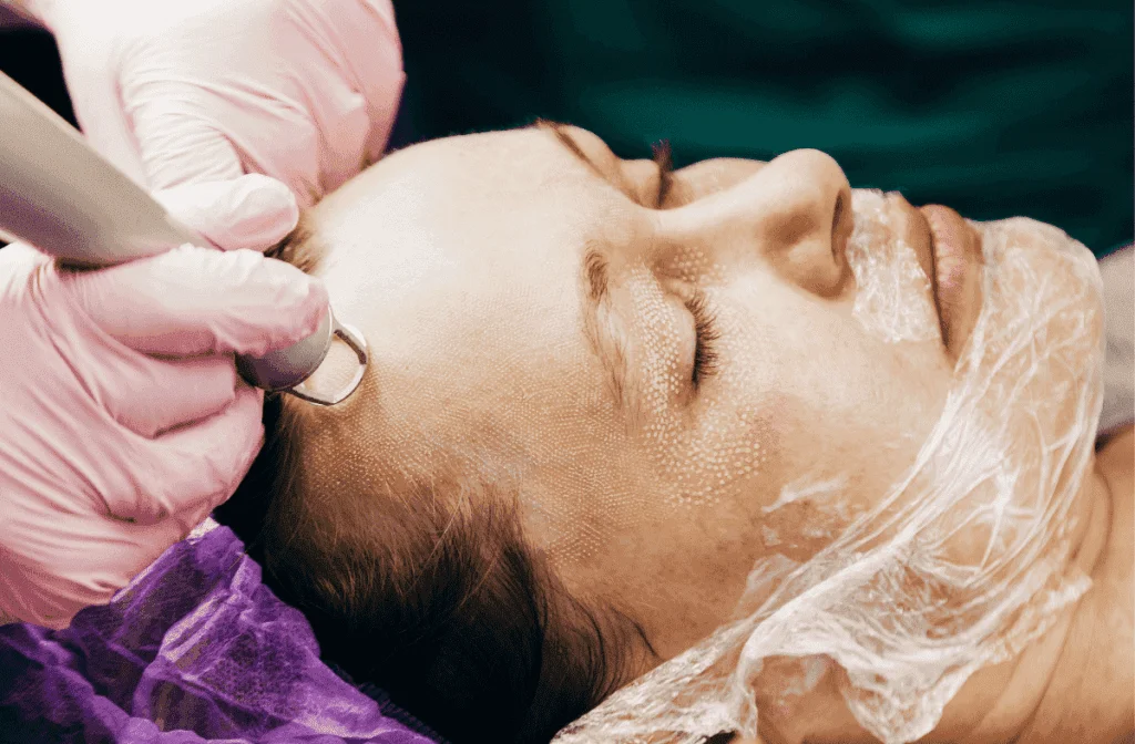 Fractional Co2 Laser Treatments