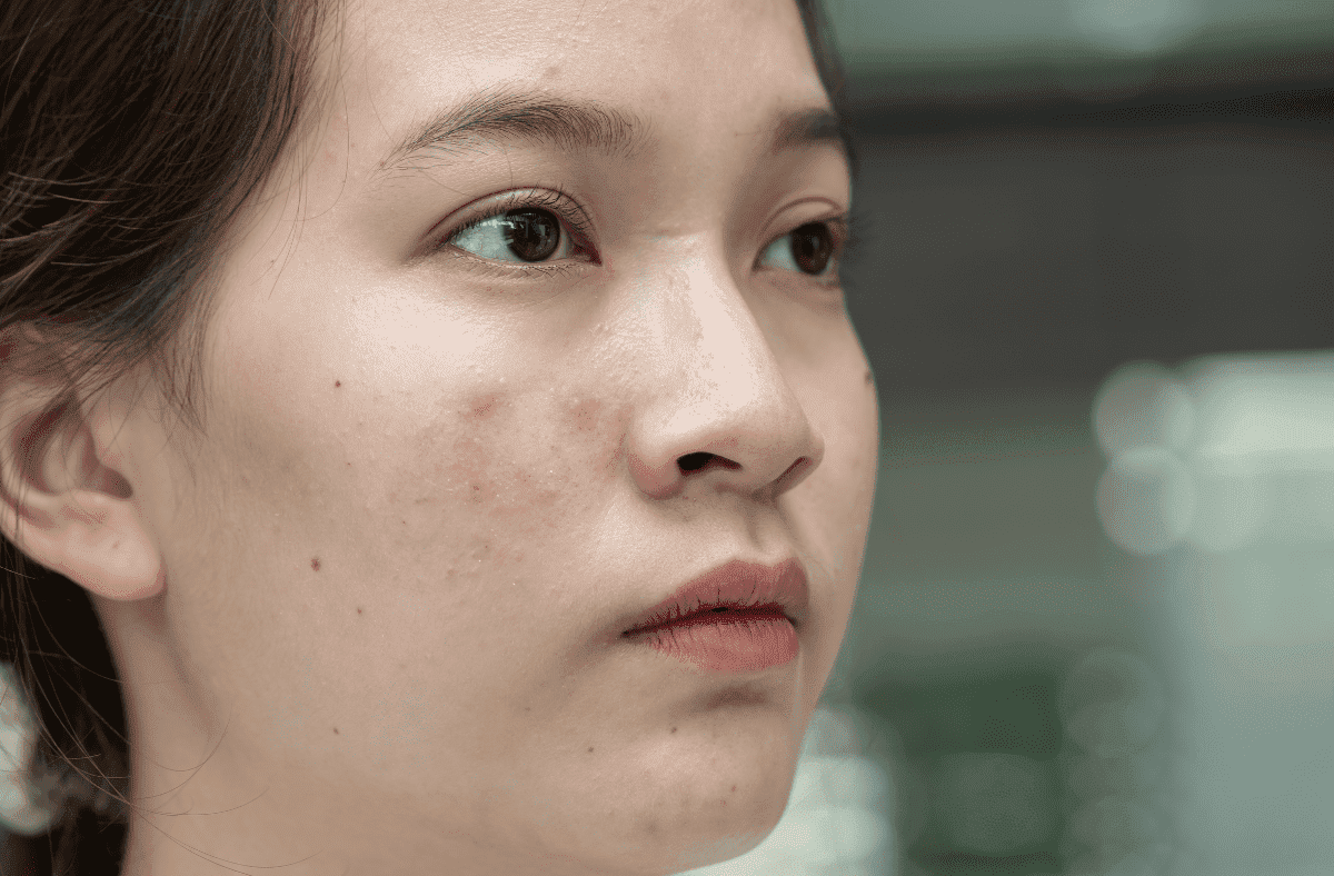 Shine Again With Non-Surgical Acne Scar Treatments