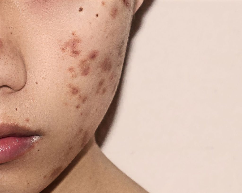 How Severe Is Your Acne And How To Treat It?