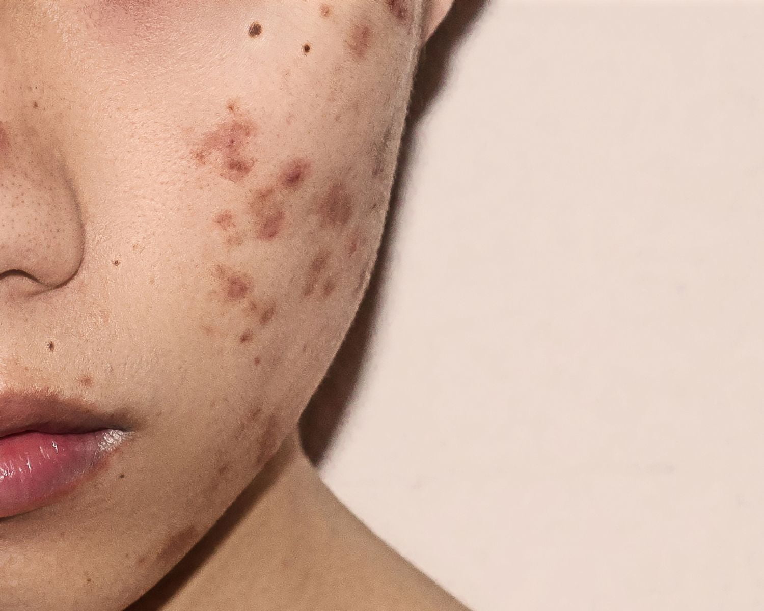 How Severe Is Your Acne And How To Treat It?