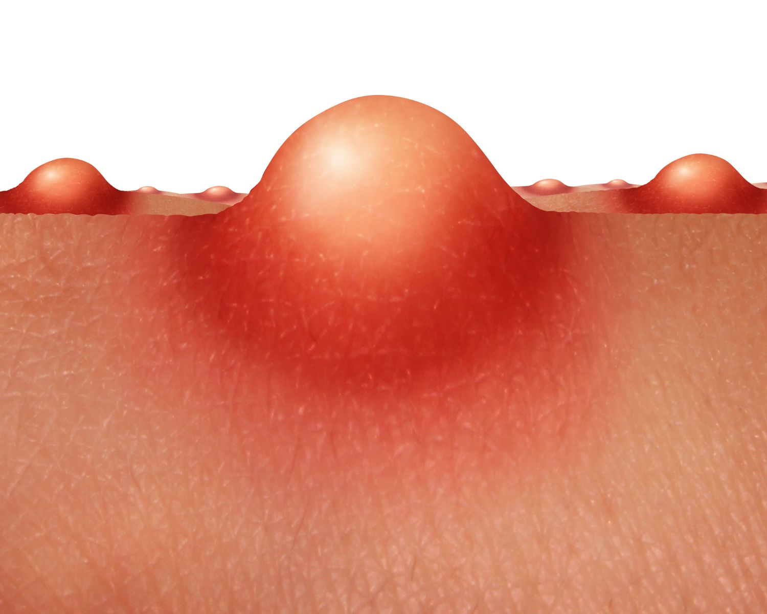 How severe is your acne?