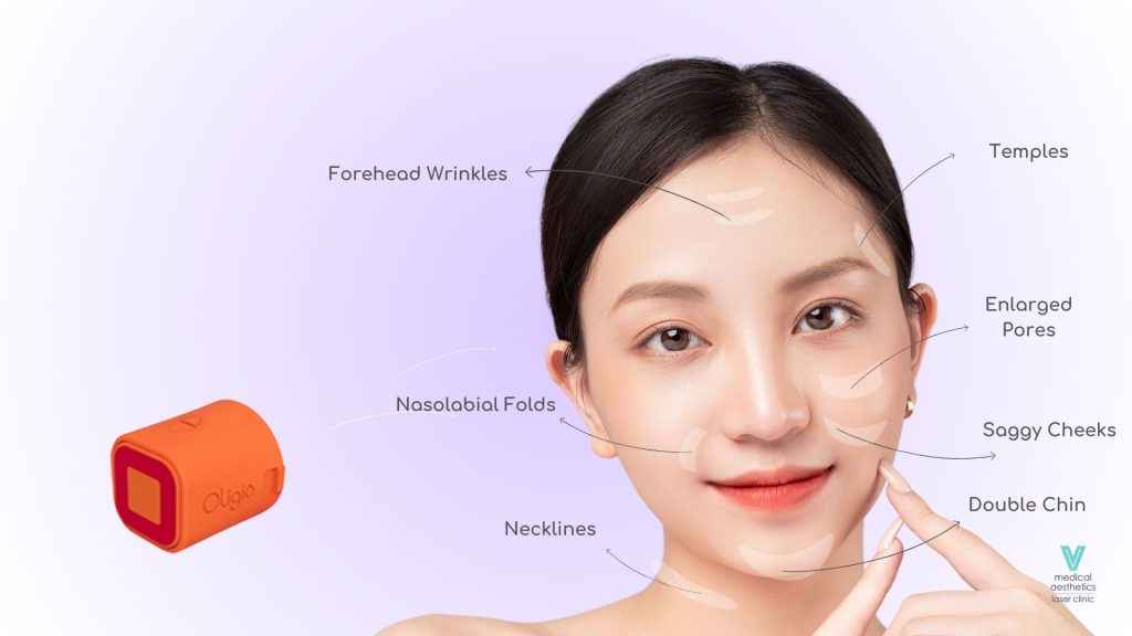 Oligio Face Tip Treatment Areas
