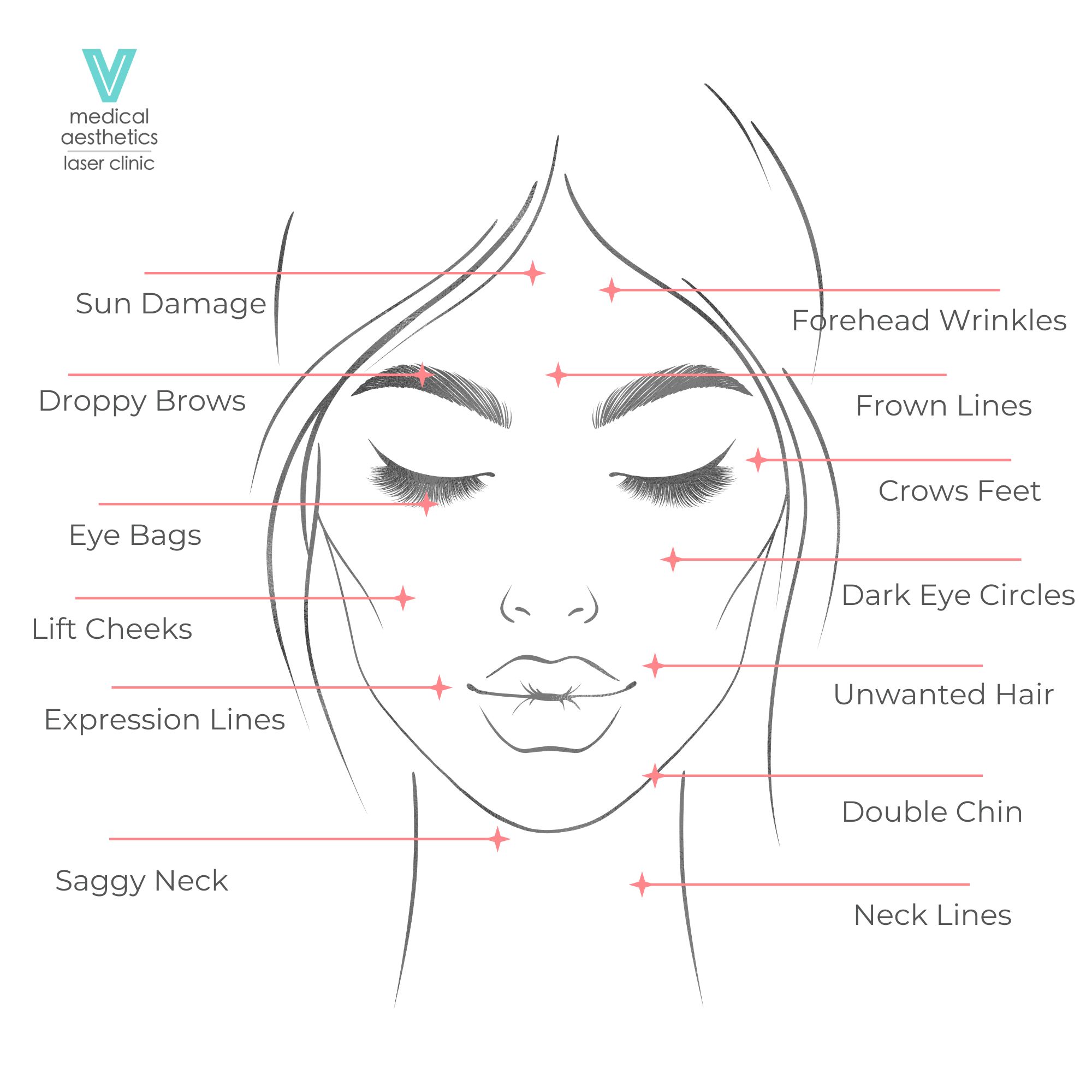 9D Perfect V Facelift Treatment Areas Summary