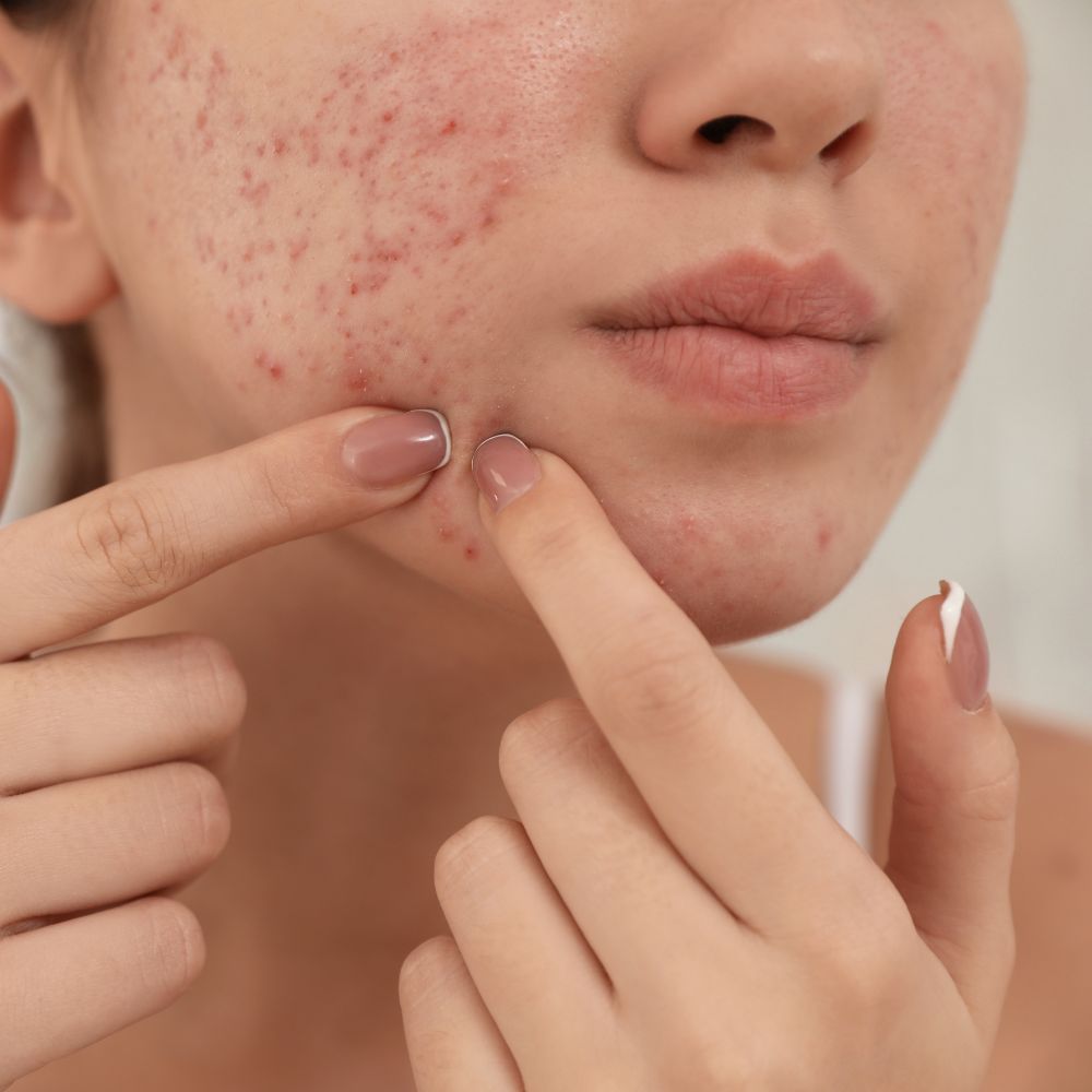 picking pimple