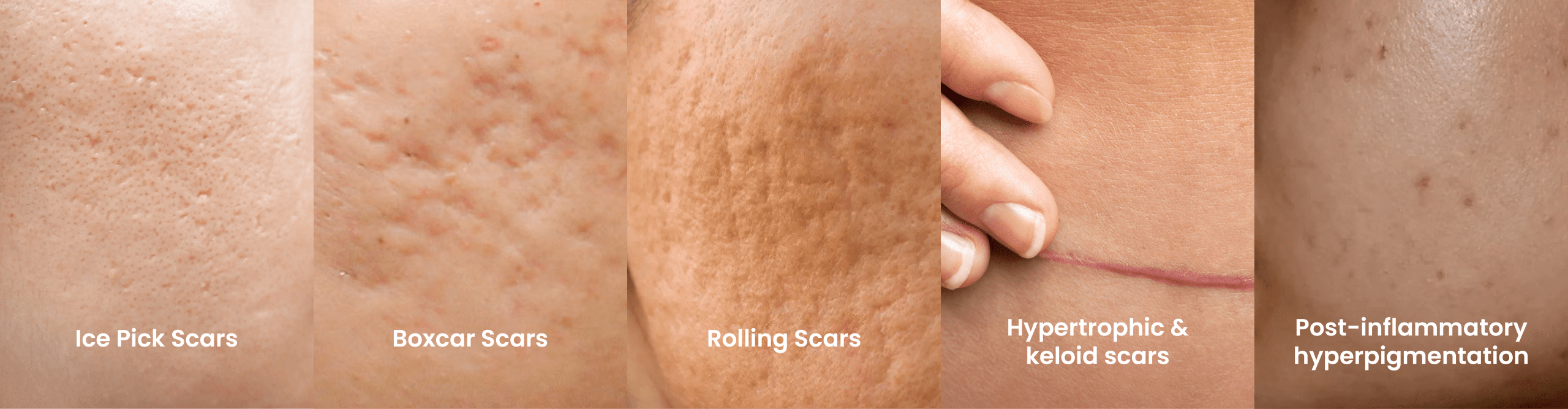 Type of Acne Scars