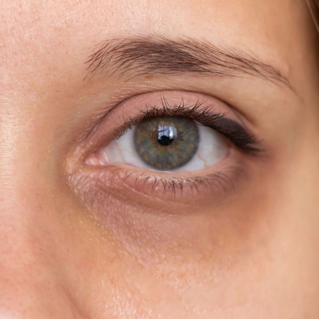 Pigmented Dark Circles