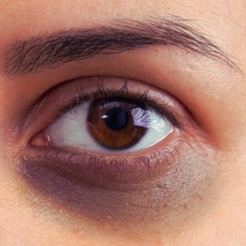 Vascular Dark Circles