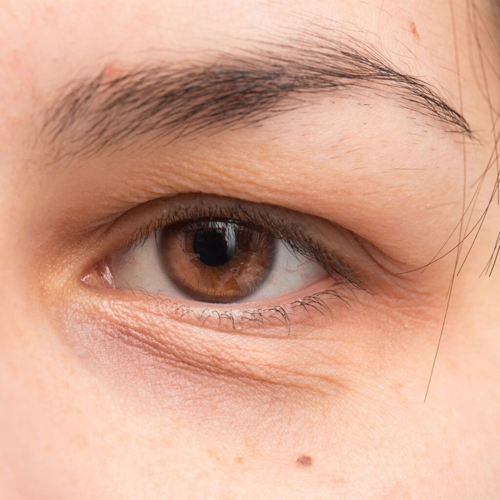 Hollow / Sunken Eye Area